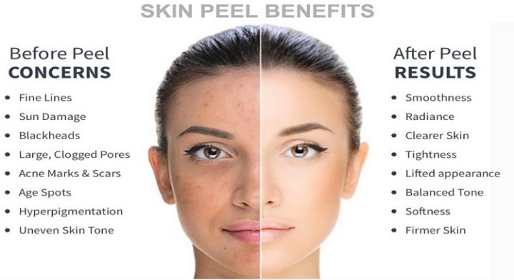 Chemical Peels Revive Aesthetic Skin Clinic Portlaoise