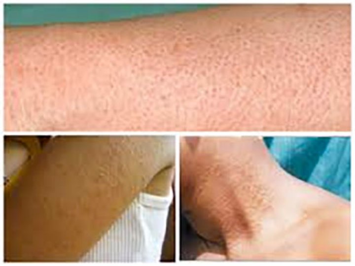 Keratosis Pilaris revive clinic