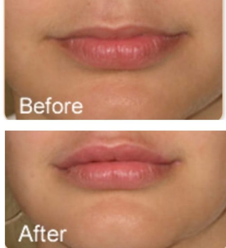 Lip Fillers revive clinic