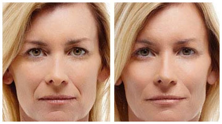 Radiesse Volumizing Filler 2 revive clinic