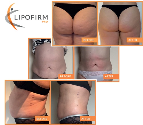 The Celebrity Secret To The Perfect Bum Using Lipofirm