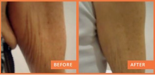 lipofirm pro