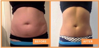 lipofirm pro