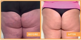 lipofirm pro