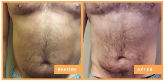 lipofirm pro